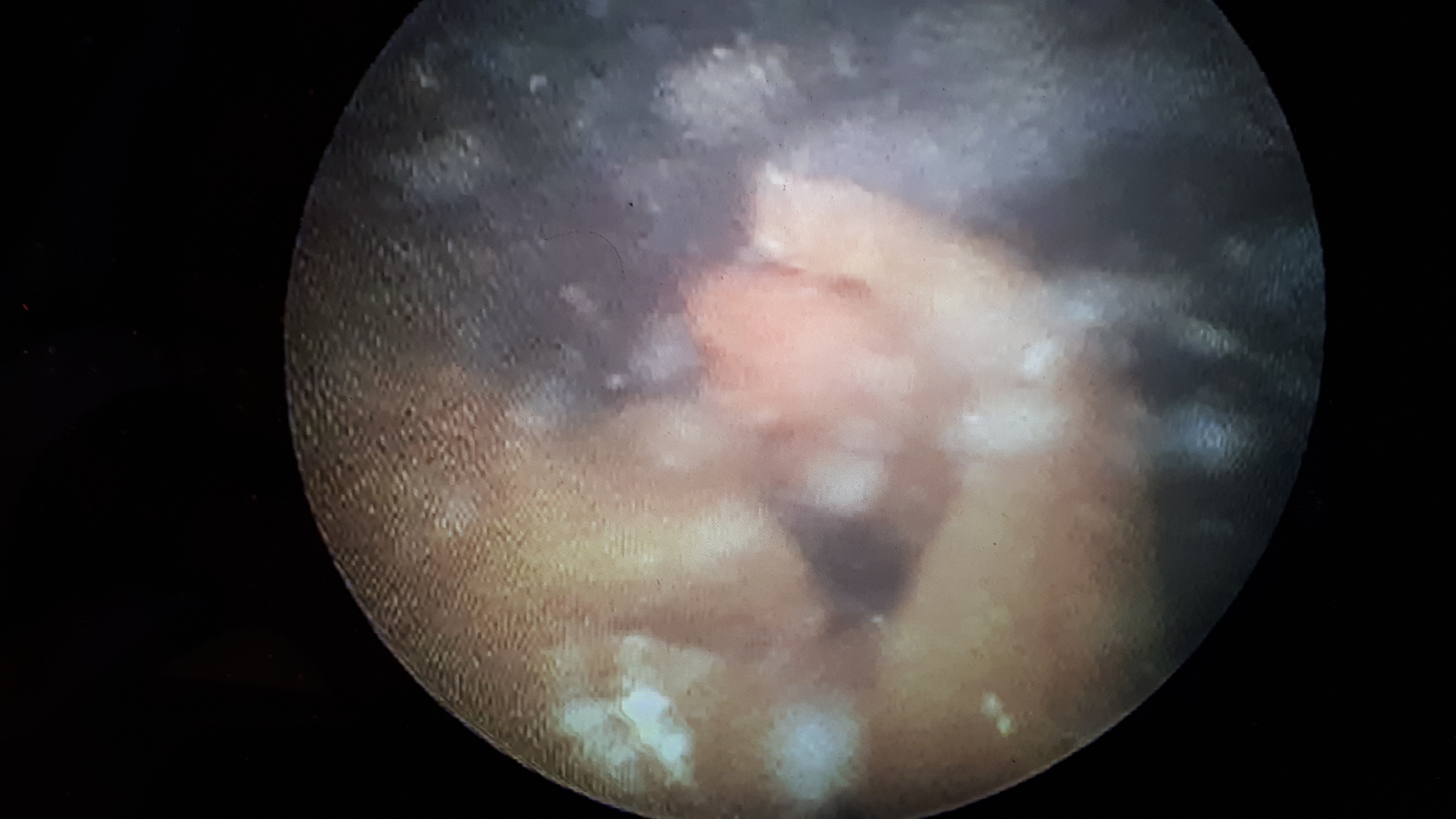 Therapeutic fetal surgeries
